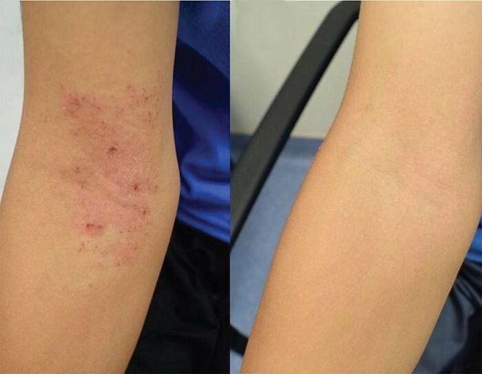 rash before and after