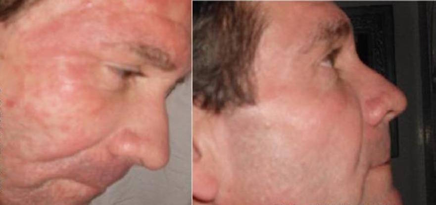Mark before and after eczema organic rosehip skincare