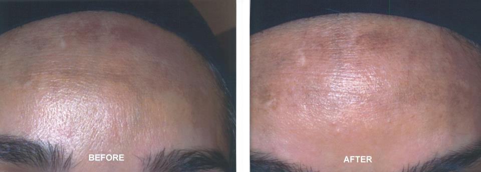 before after pigmentation